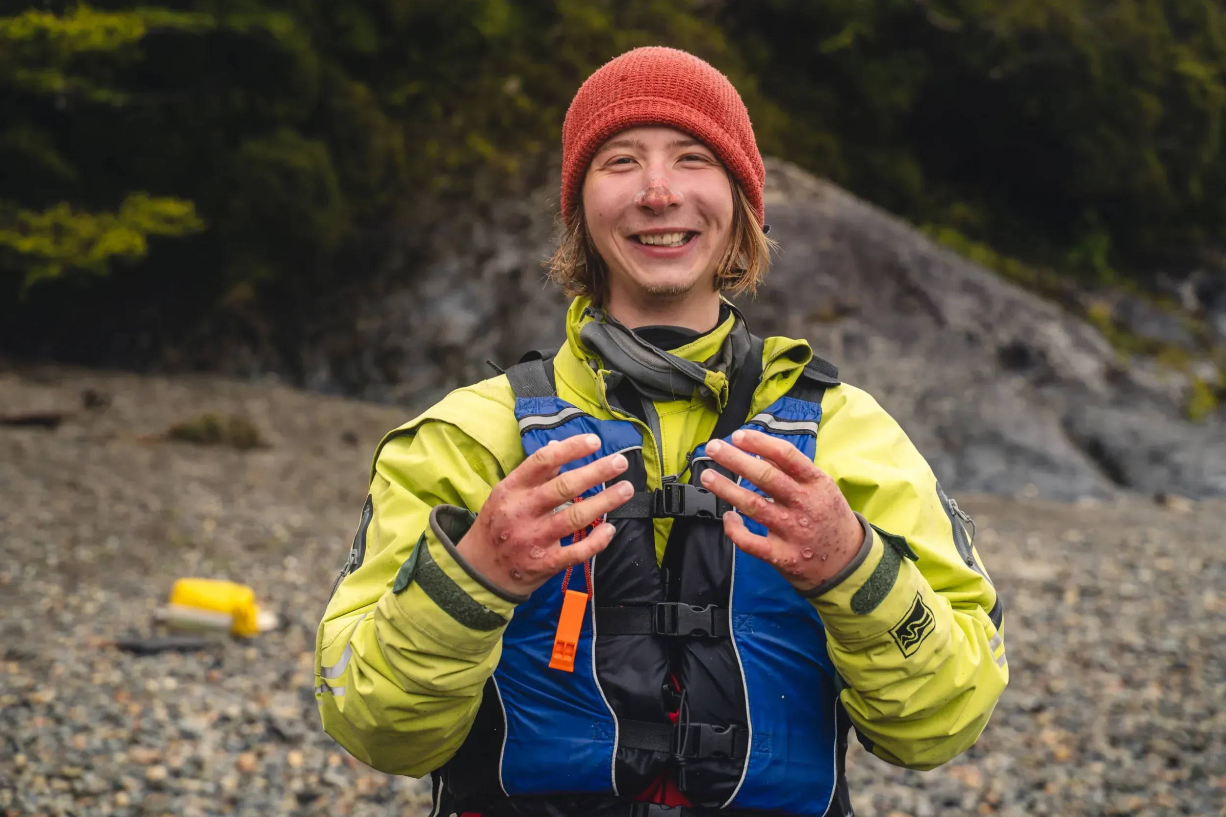 a person in a life jacket holds up blistered hands